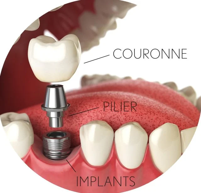 Implant dentaire